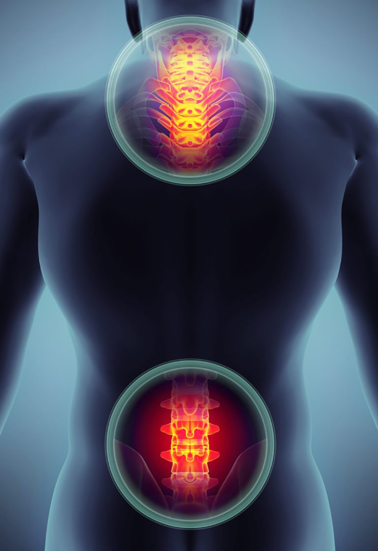 Cervical and Lumbar Radiculopathy