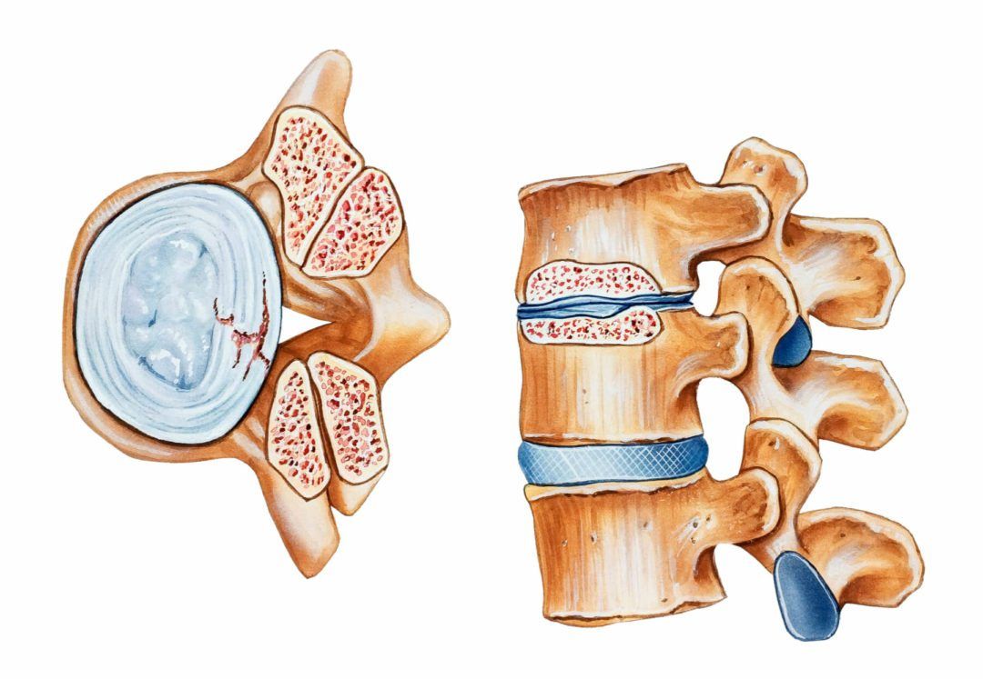 Microdisectomy » Columbia, SC | Orthopedic Surgeon | Michael W. Peelle, MD