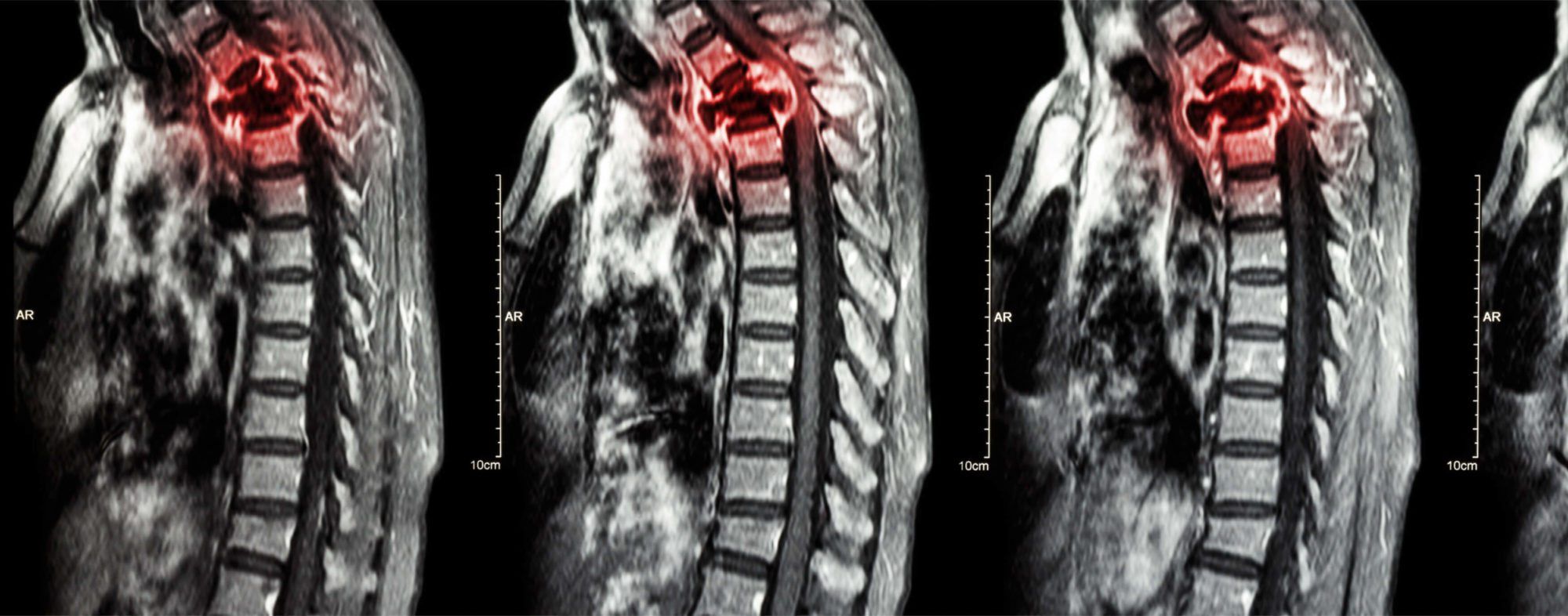 myelopathy-columbia-sc-orthopedic-surgeon-michael-w-peelle-md